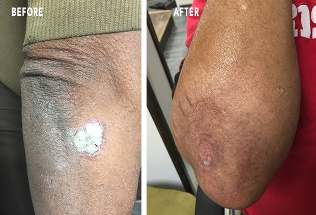 Psoriasis