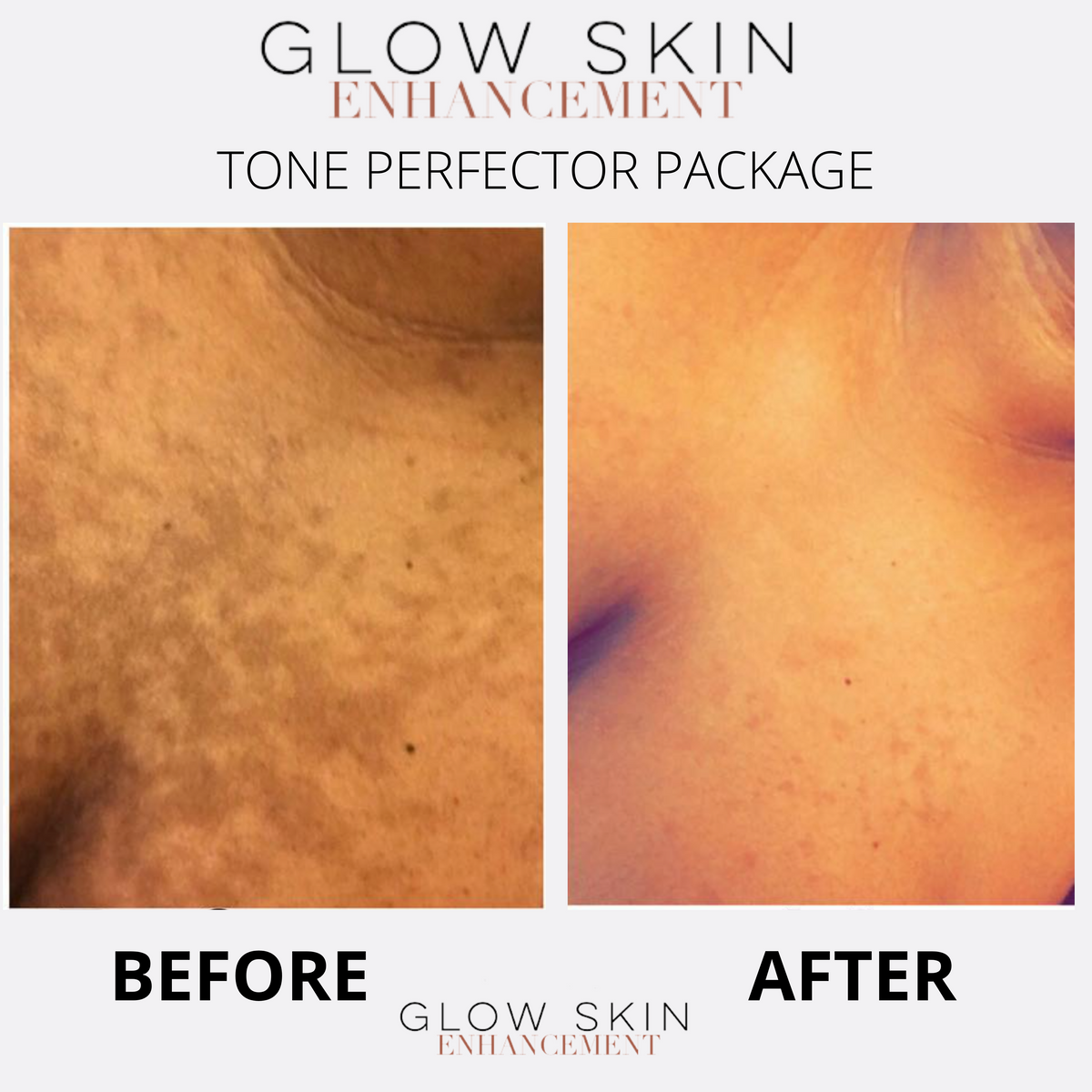 TONER PERFECTOR PACKAGE– Glow Skin Enhancement