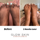 HAND-FEET, KNEE-ELBOW RENEWAL KIT