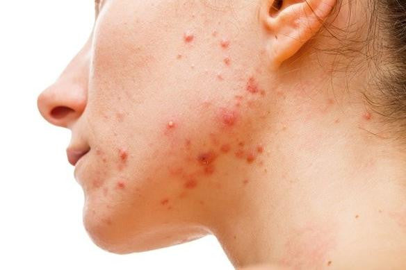 Genetics of Acne