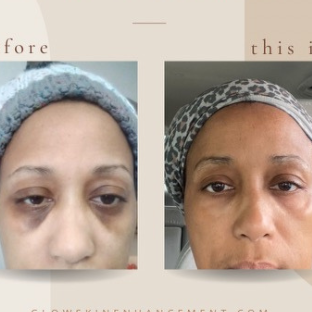 DARK CIRCLE REMOVER EYE CREAM
