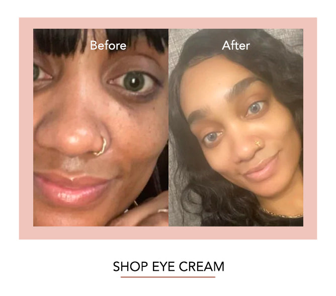 EYE Cream (DARK CIRCLE REMOVER)